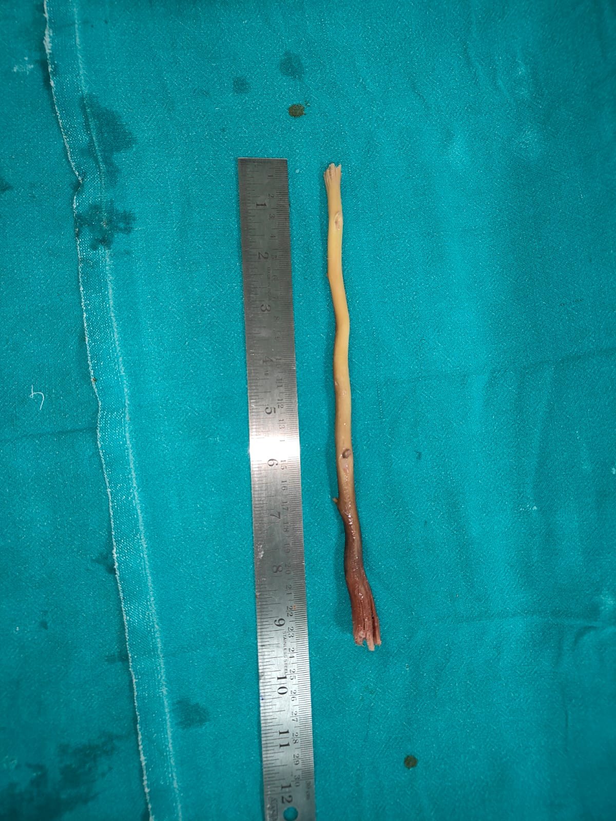 ବୃଦ୍ଧଙ୍କ ପେଟରୁ ବାହାରିଲା ୯ ଇଞ୍ଚର ଦାନ୍ତକାଠି